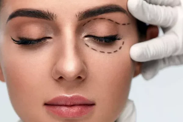 What is Eyelid Surgery?